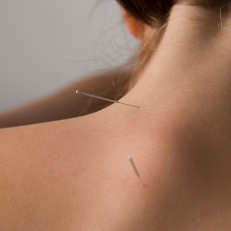 Acupuncture treatment
