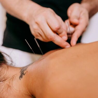 Acupuncture for pain management