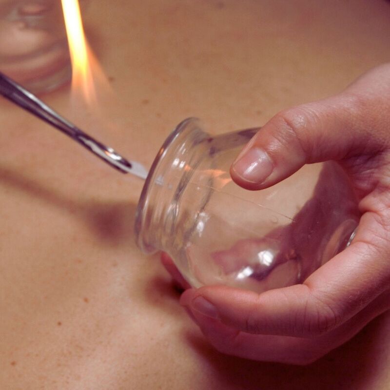 Fire cupping in Albany